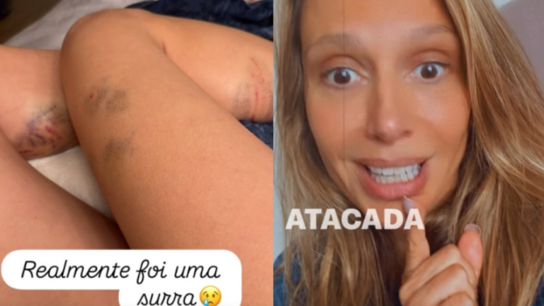 Luisa Mell exibe hematomas nas pernas e revela que foi atacada por cachorros: ‘A culpa foi minha’